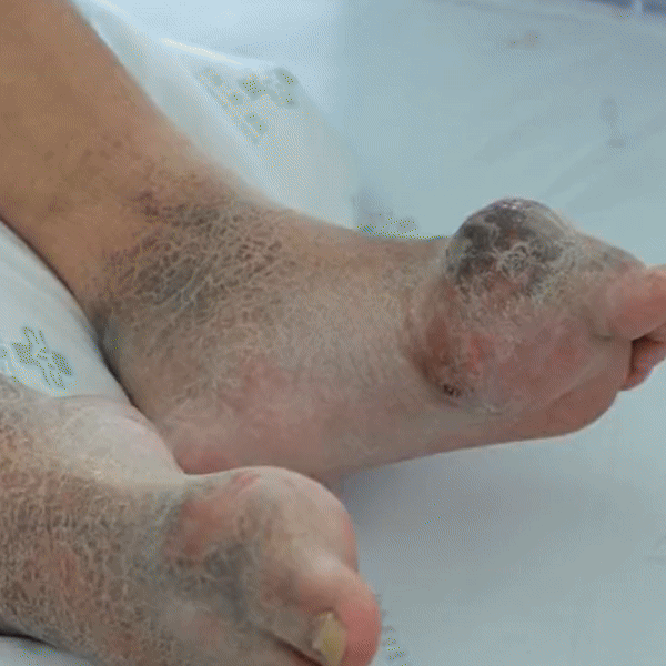 🥇🥈Pachete de detoxifiere și drenaj limfatic pentru băi de picioare(Reducere limitată 30 minute🔥)